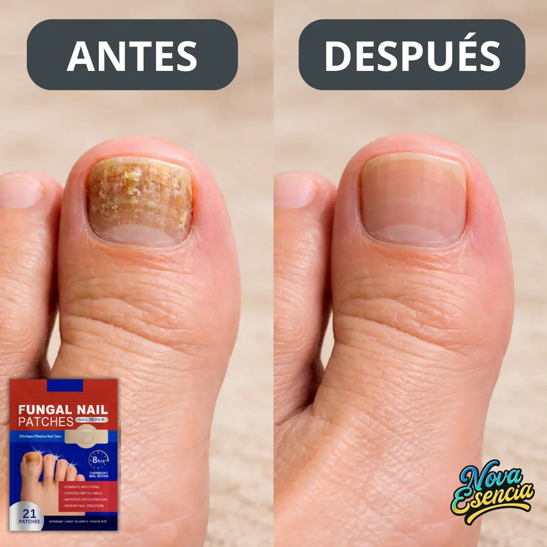Parches Antihongos para Uñas
